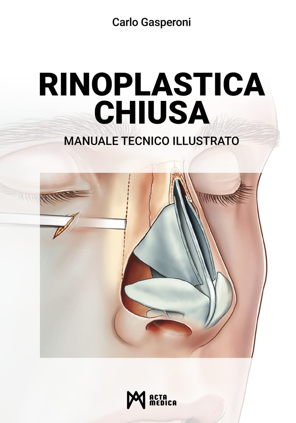 Rinoplastica chiusa - Manuale tecnico illustrato