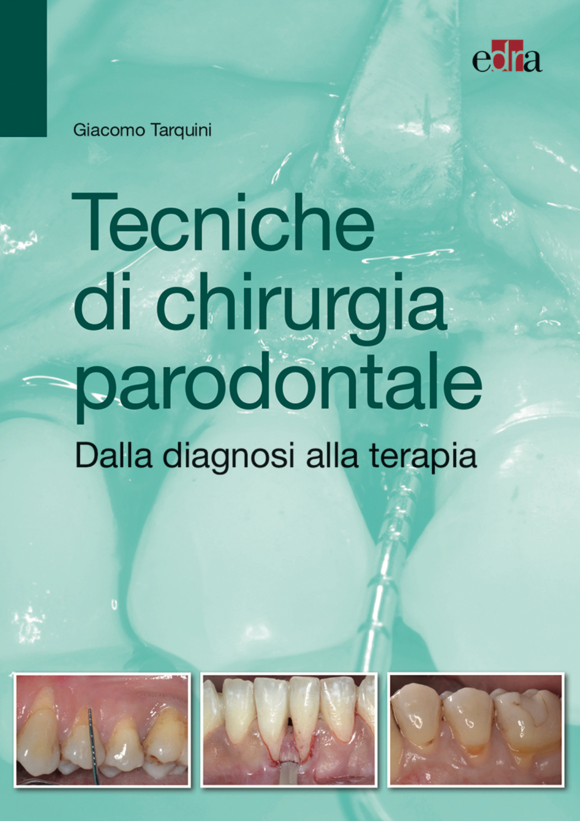 Tecniche di chirurgia parodontale - Dalla diagnosi alla terapia