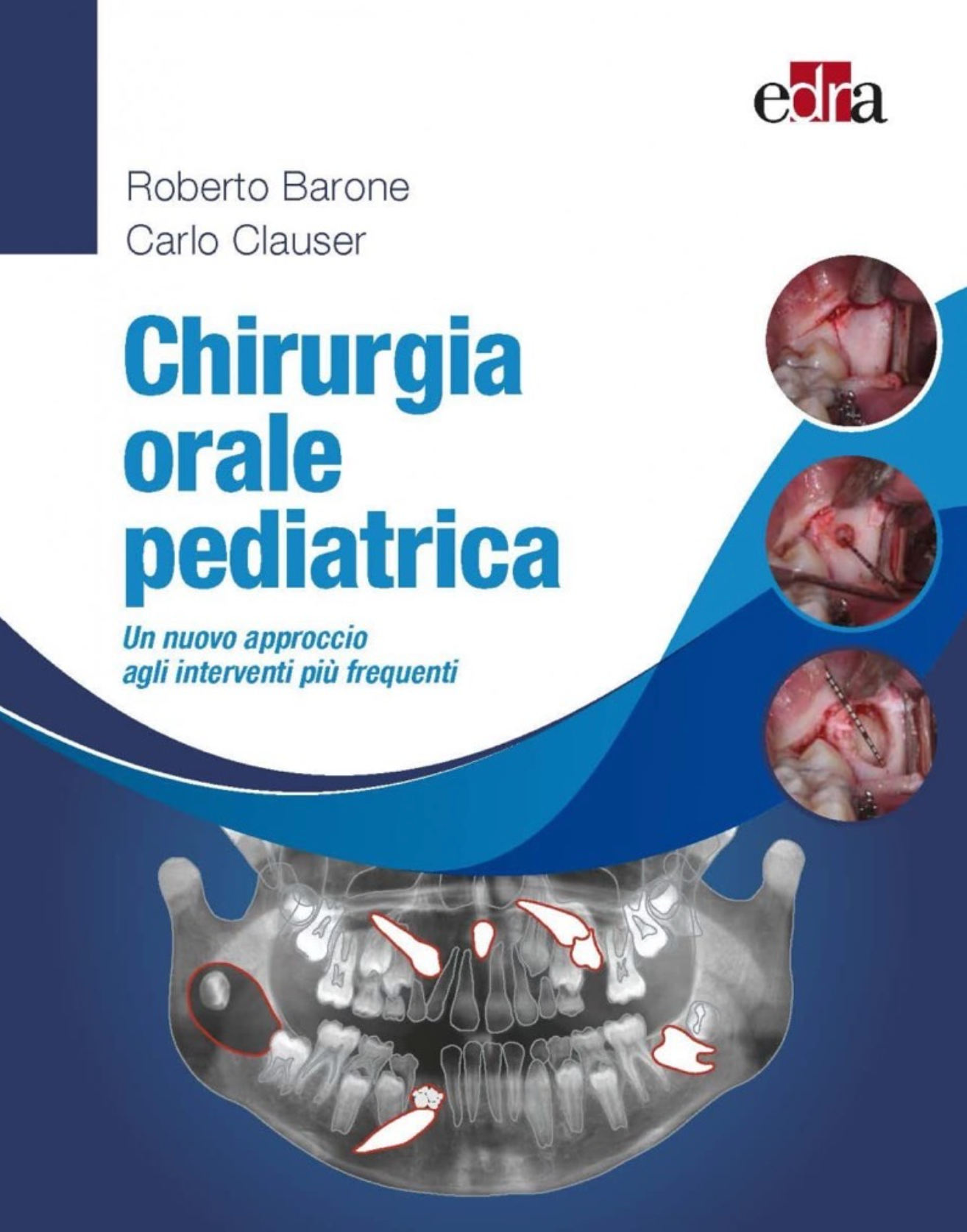 Chirurgia orale pediatrica . Un nuovo approccio agli interventi più frequenti