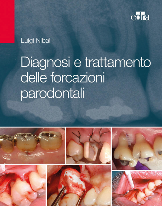 Diagnosi e trattamento delle forcazioni parodontali