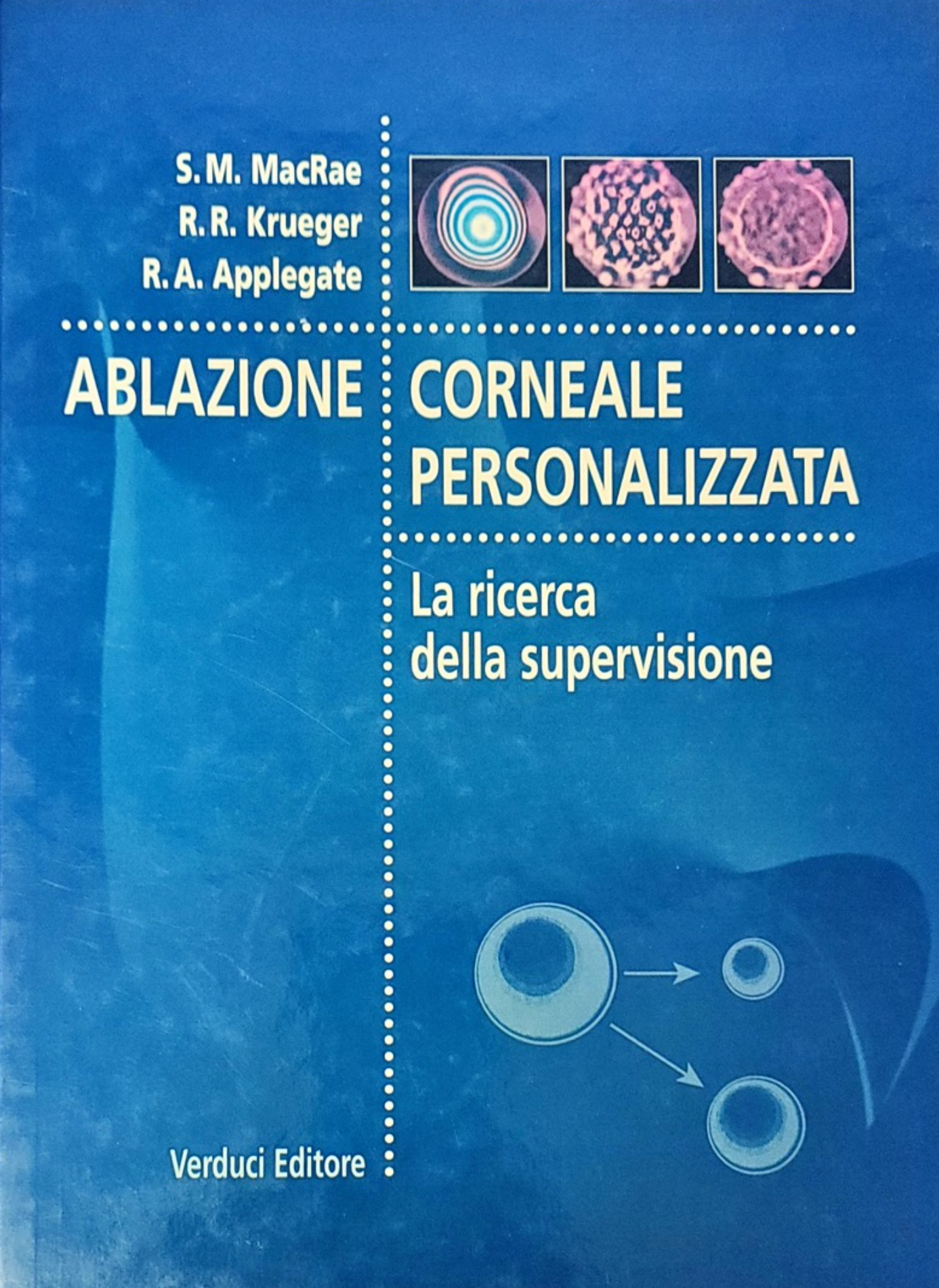 Ablazione corneale personalizzata - La ricerca della supervisione