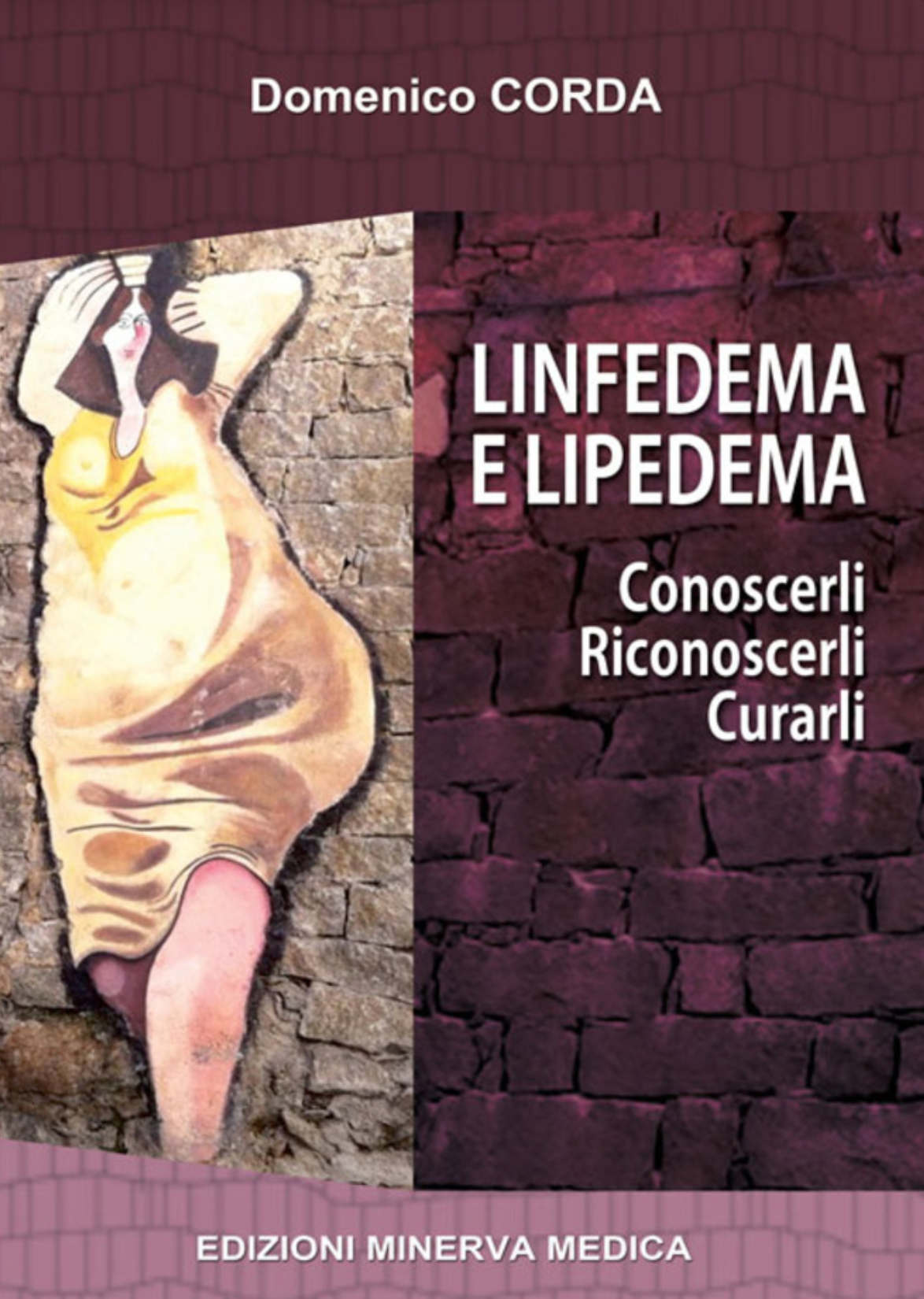 Linfedema e lipedema - Conoscerli - Riconoscerli - Curarli