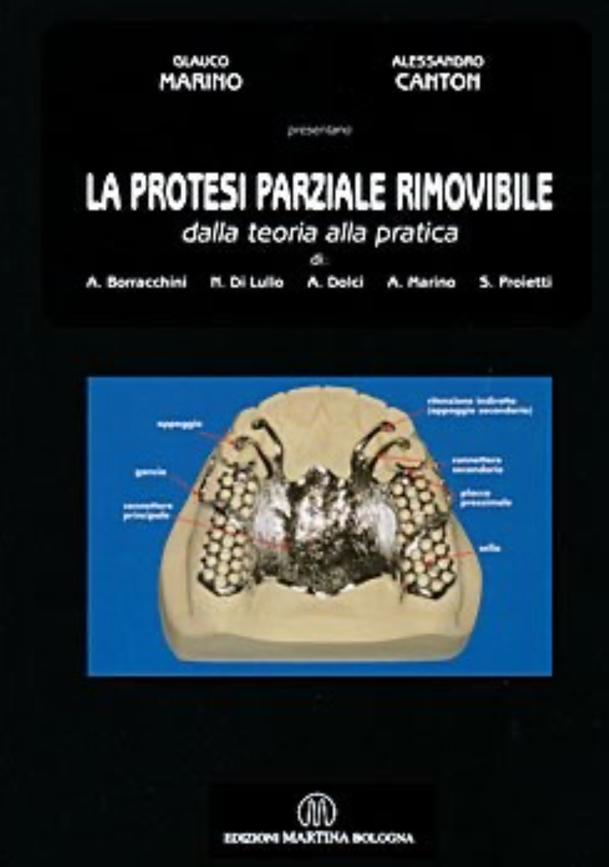 La protesi parziale rimovibile - Dalla teoria alla pratica