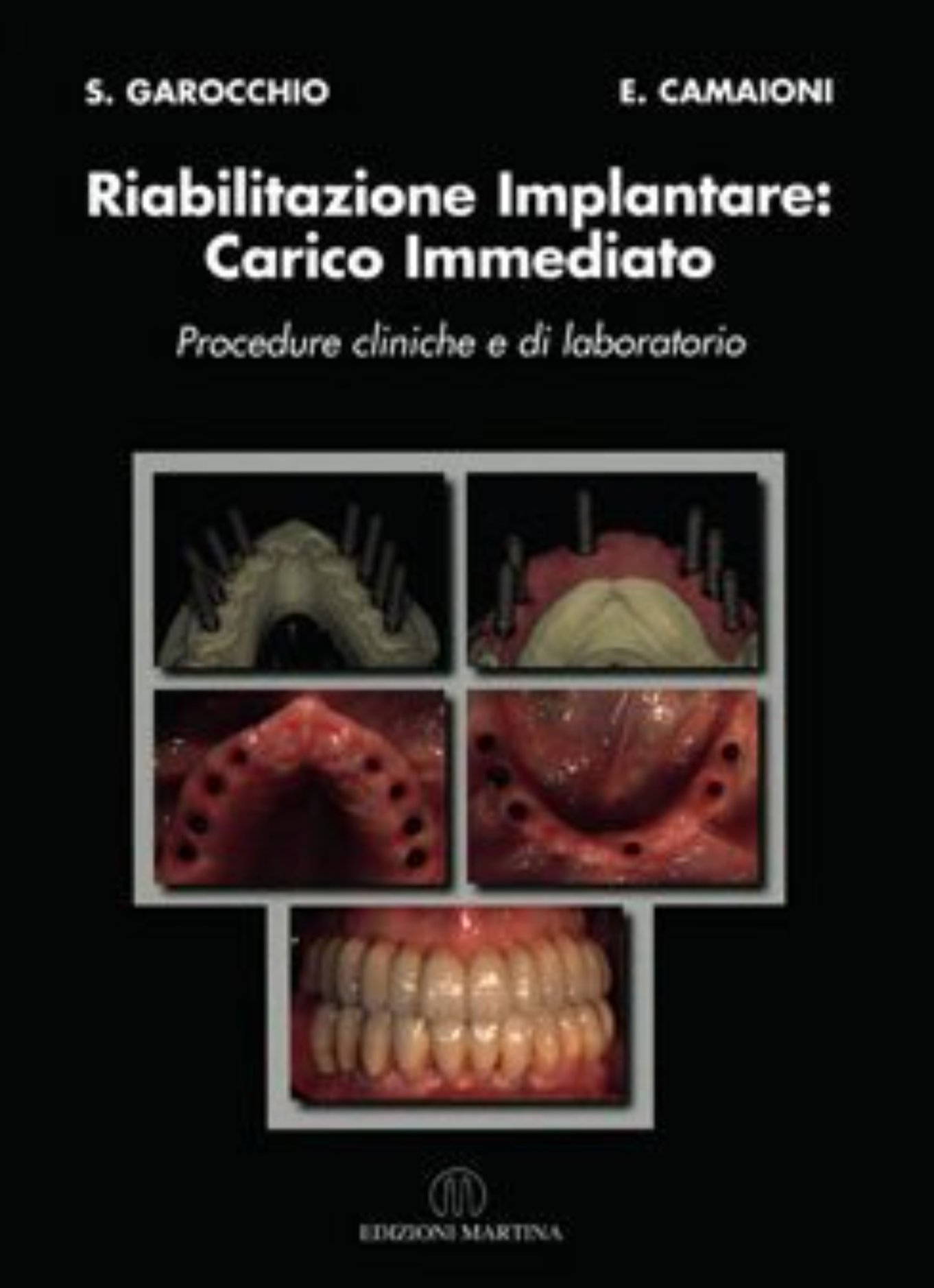 Riabilitazione implantare: carico immediato - Procedure cliniche e di laboratorio